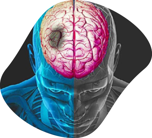 Acute Stroke Image